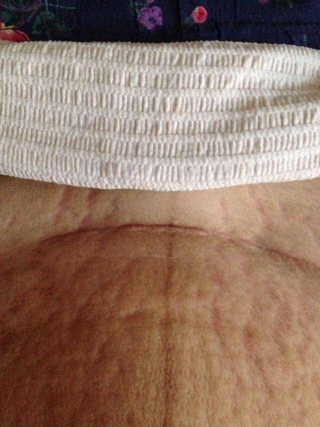 剖腹产疤痕太丑陋,被老公嫌弃被自己唾弃,做妈妈好心酸啊