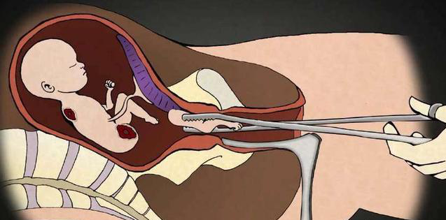 怀孕9个月打胎,遭受不仅是身体伤害,还有这些影响|打胎|引产|胎儿