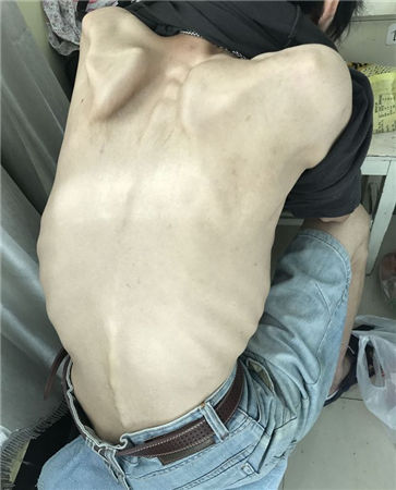 男孩患暴食症骨瘦如柴,一顿吃200个饺子后狂吐不止