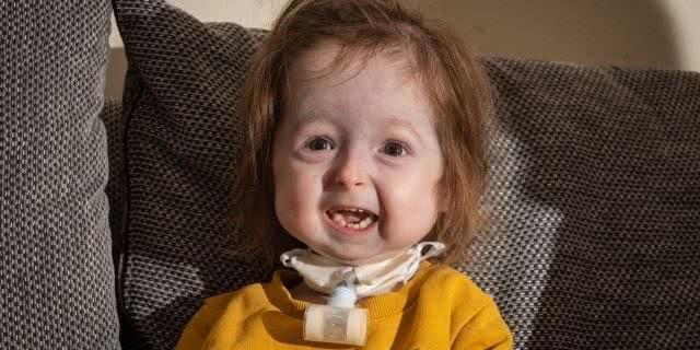 2岁英国女童患全球仅此一例的怪病,面容畸形,体重不足14斤