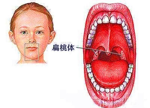 正常喉咙和发炎喉咙图片