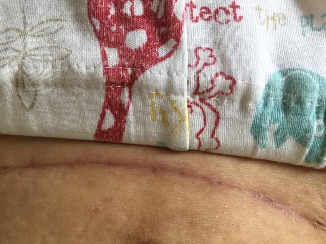 大夫:3个"后遗症" 别忽视