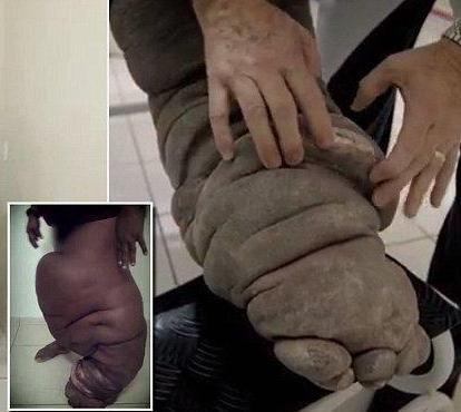 男子左腿变异成大象腿,走路都成困难,"真凶"让人害怕又无奈