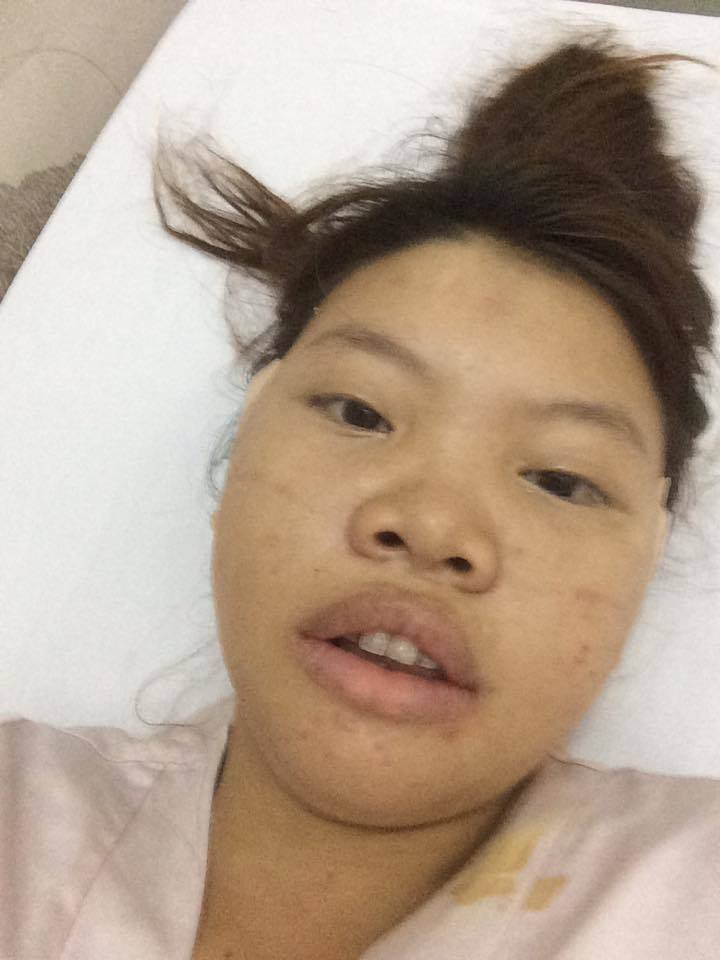 5亿越南盾(约计人民币10万元),来到了整容的医院,开始了全脸整容手术