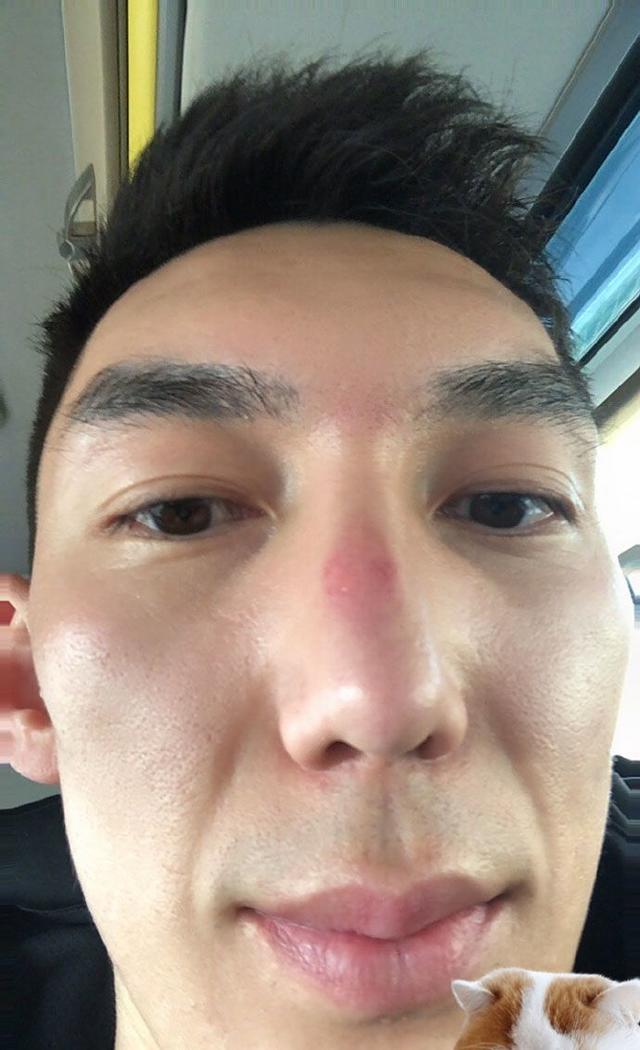 在上赛季广东和新疆的总决赛期间,可兰白克的两个大门牙出现了明显的