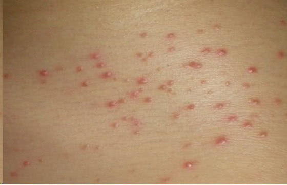 艾滋病或已"上门",5类人需马上去看医生|艾滋病|症状|艾滋病患者_新浪