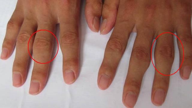 手指关节粗大,是一种病吗?