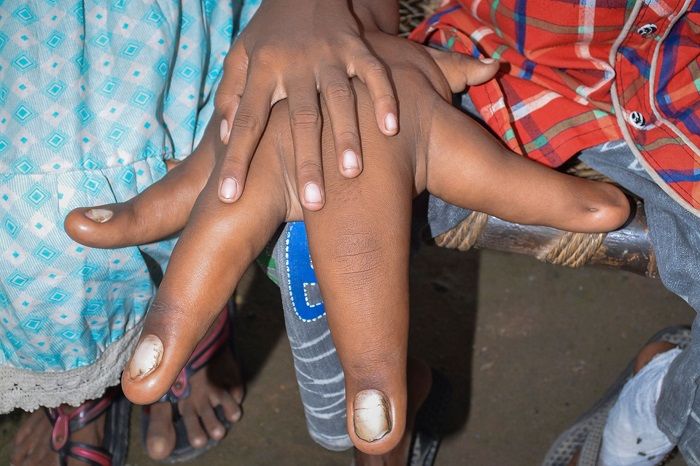 8岁男孩长35厘米"巨手",就连医生也束手无策