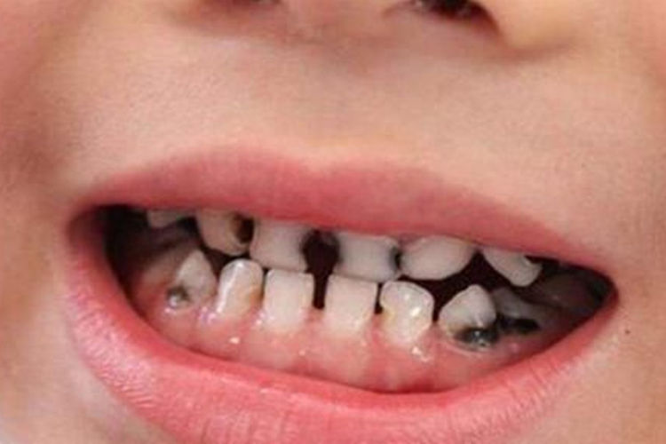 老师跟圆圆的妈妈沟通之后,才了解到,圆圆是因为牙齿发黑才变成这样的