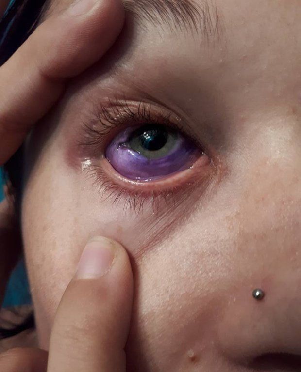 女子眼球纹身失败,从那以后就开始流紫色的眼泪