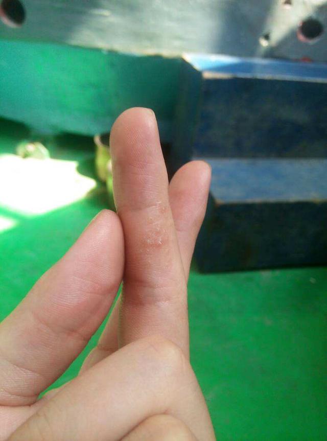 手脚总长"小水泡"还很痒?可能是身体这里出了问题,别大意