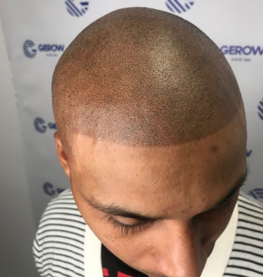 秃顶男子想要头发无奈请纹身师纹头发效果令人无奈