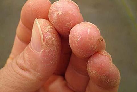 手癣|脱皮|手指_新浪新闻