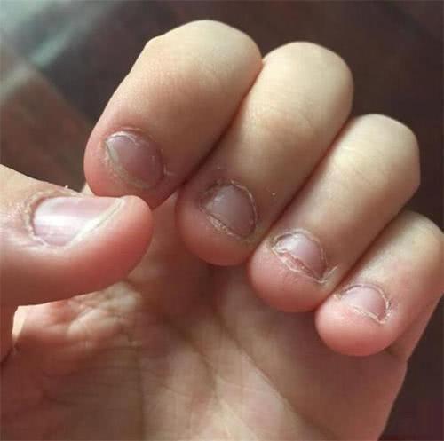 爱啃手指甲的孩子,长大之后会怎么样?医生:逃不开这两个结局