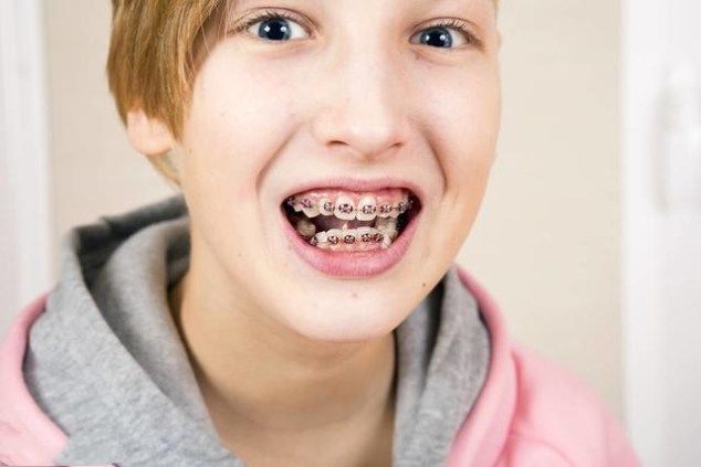 儿童箍牙齿图片过程图片