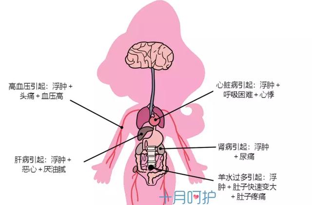 生理性浮肿生理性浮肿的特点:多发生在下肢,而且下午及夜晚的浮肿要比