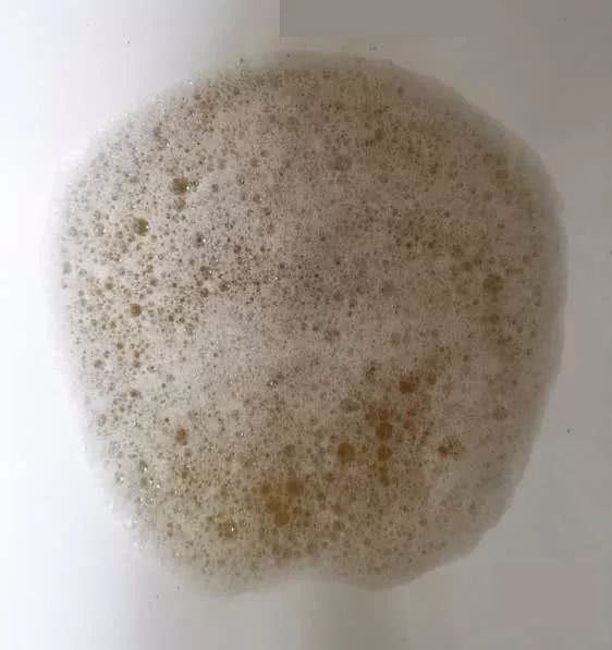 这样的变化肉眼直观可见,尤其是晨起的第一次尿液,变黄跟茶叶一样