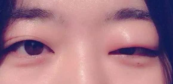 尿毒症多是拖出来的一旦晨起出现3异象尽早养肾别大意