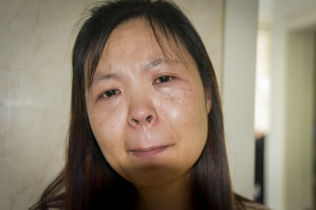 14岁花季少女因病眼睛即将失明治疗的关键时刻父亲却不见了