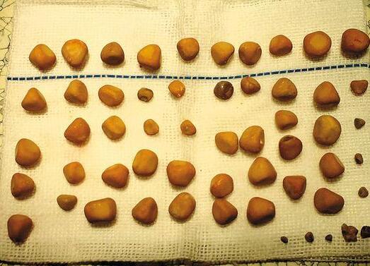 体内查出肾结石只要你能做到这5件事能够帮助身体排石
