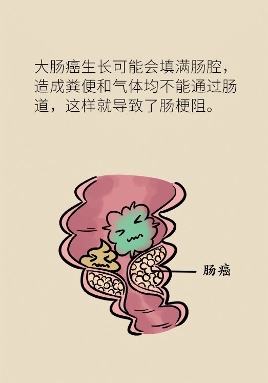 总是放屁,而且很臭,是肠癌的信号吗?