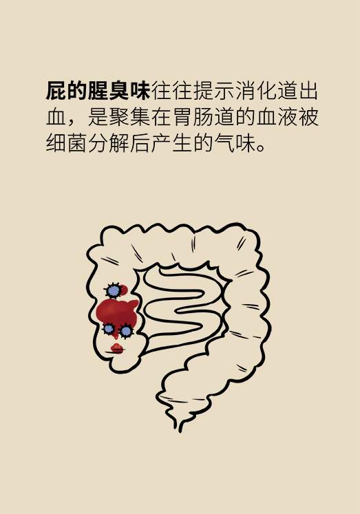 总是放屁,而且很臭,是肠癌的信号吗?