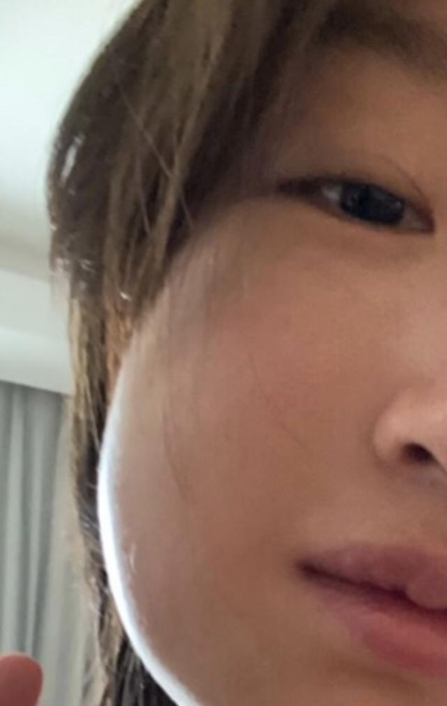 继乔欣拔牙之后,周冬雨拔智齿致脸部肿胀,网友调侃像被马蜂蛰过