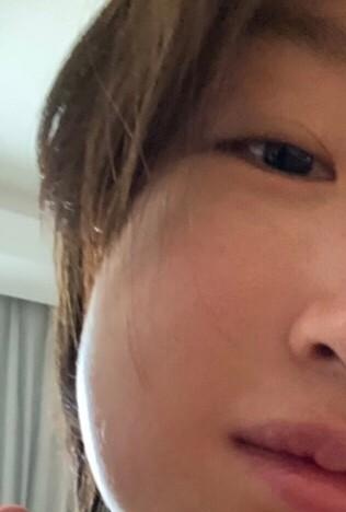 周冬雨拔完智齿脸肿,哈哈哈哈有点可爱又有点惨