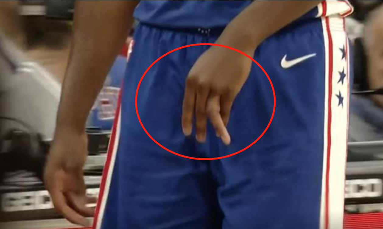 恩比德手指45度脱臼近照曝光,掰回继续打!在nba挣钱没那么容易