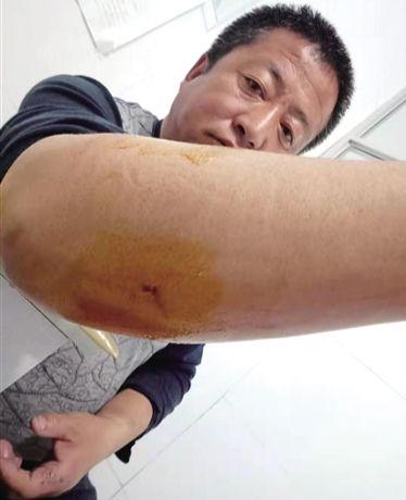 内蒙古包头牧民遭遇"狼搭肩",差点被狼一击致命