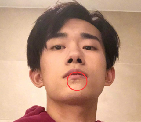 易烊千玺唇酒窝被夸吴彦祖同款帅哥标配,照片放大后疑似肉瘤增生