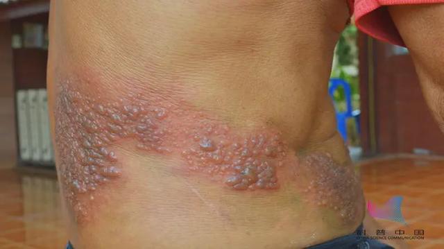 蛇缠腰这种病缠满腰一圈就会致命现在看还不晚