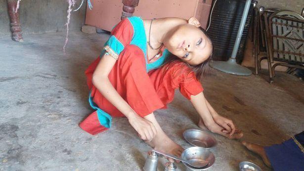 9岁小女孩患罕见怪病,脖子弯曲成90度,最大心愿走进校园上课