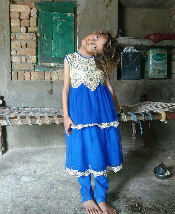 9岁小女孩患罕见怪病,脖子弯曲成90度,最大心愿走进校园上课