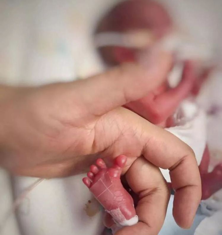 极早产婴儿出生仅29厘米,体重580克,在保温箱住140天后出院