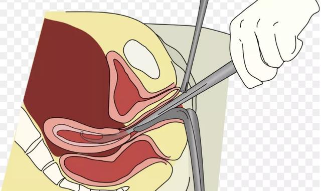 流产对身体有什么伤害,这些是肉眼看不到的!|盆腔炎|子宫|子宫内膜_新