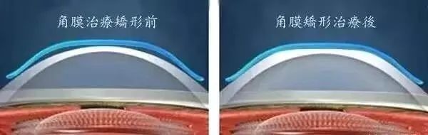 OK镜就能拯救娃的近视么？