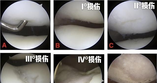 下图当中是不同程度的髌骨软骨软化磨损以后,在关节镜下的影像学资料