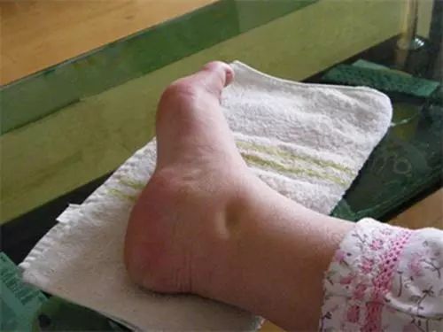 尿毒症,多数是"拖"出来的,身体出现5种症状,最好去做个尿检