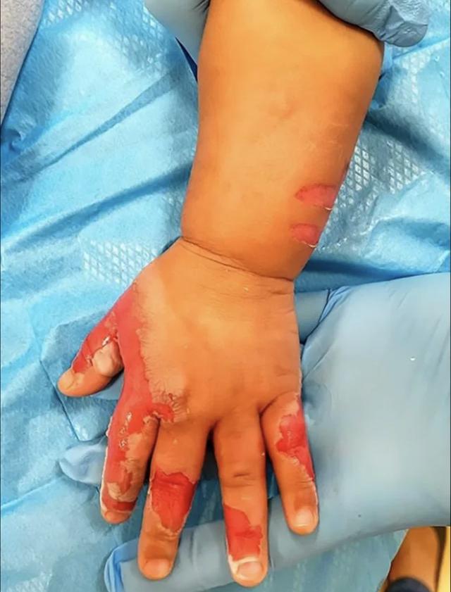 新加坡保姆为回家休息用沸水烧伤16个月大婴儿手臂