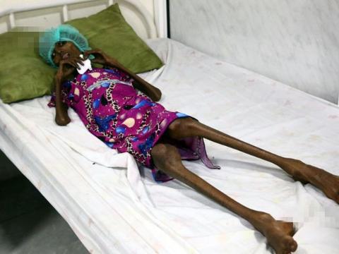 女孩因过分爱美患神经性厌食严重营养不良,像一具"行走的骷髅"