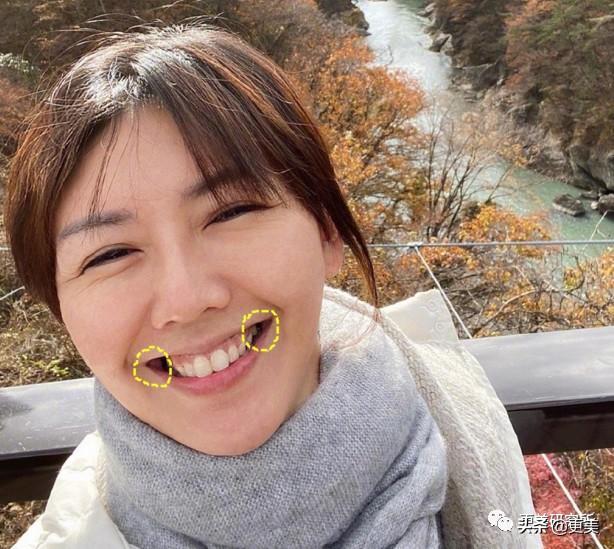 爆红30天后宋轶就去动了牙,怎么灵气就变了?