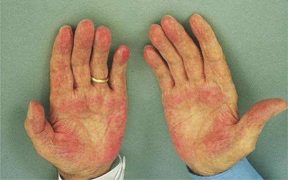 酒瘾大的人,若手上出现3个异常,说明肝已受损,戒酒已刻不容缓