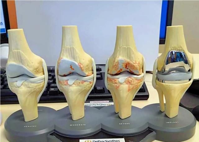 花甲之年开始膝盖疼,检查发现退变该咋办|变性|关节|骨关节炎_新浪