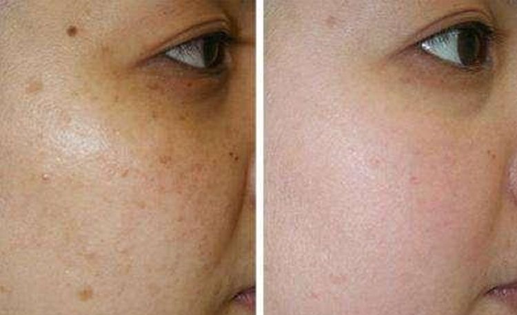 牙膏加上它敷脸,15天下来皮肤变得白净又水嫩,色斑皱纹也变淡了