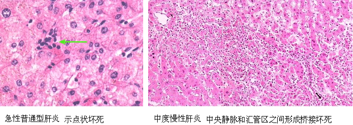 结构,在受到免疫细胞清除过程中引发持续炎症,比较常见的是肝细胞坏死