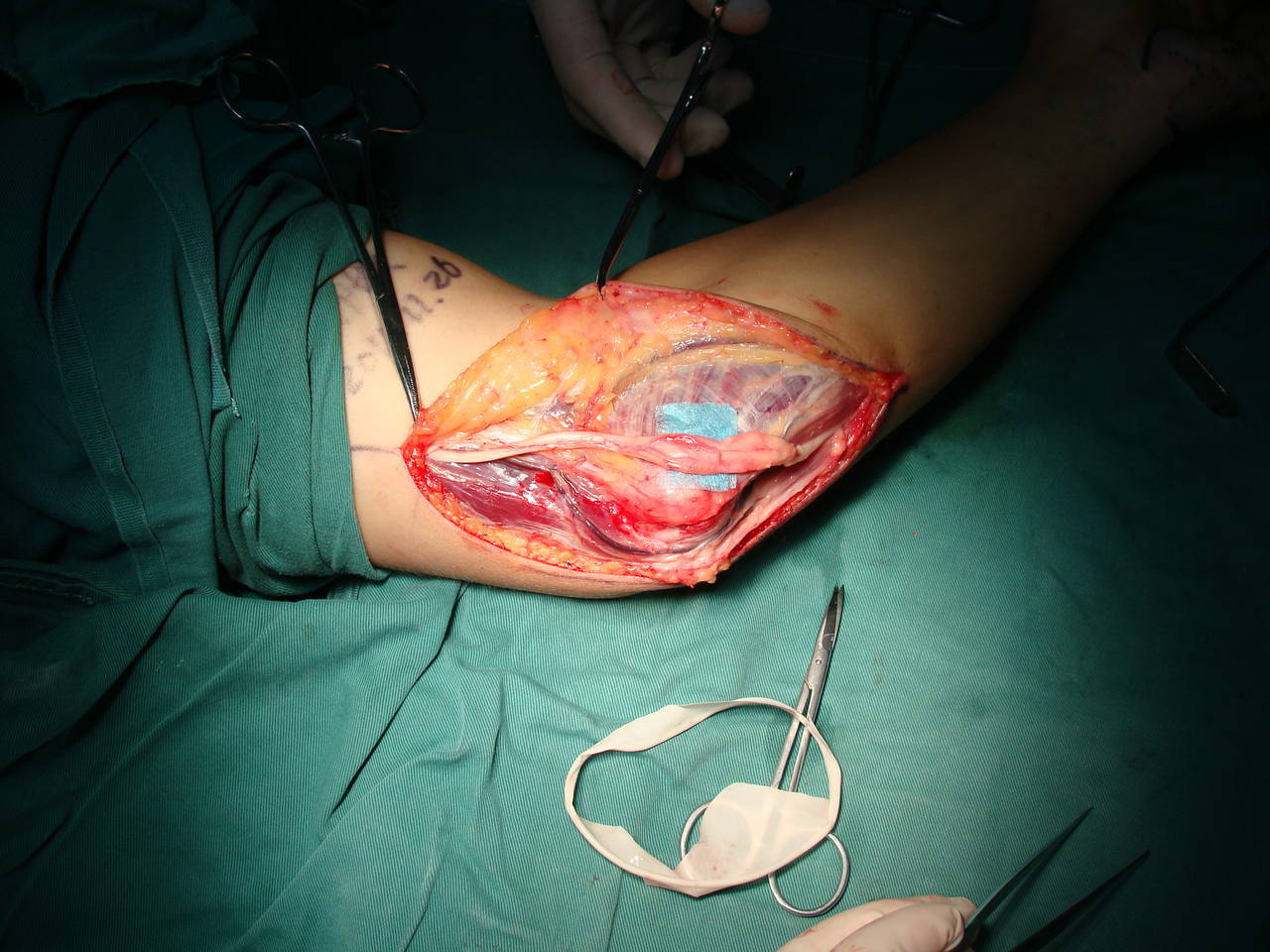 正文  手术治疗:如果保守治疗无效,可选择尺神经减压手术,术后经过