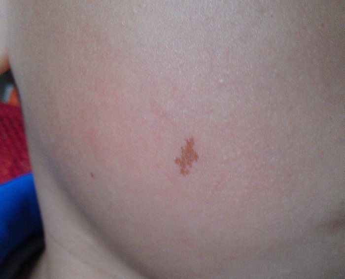 哪些胎记需要去除 北京胎记血管瘤症状有哪些