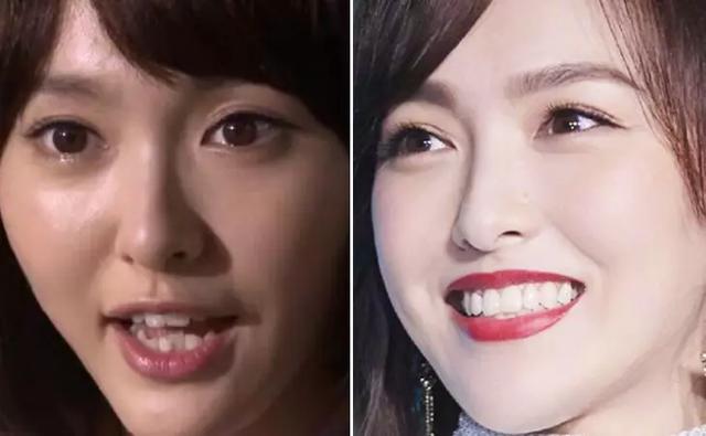 对于我们普通人来说,如果你的牙齿歪歪扭扭,缝隙大,"兜齿",甚至是