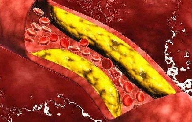 血脂高的血管图片图片